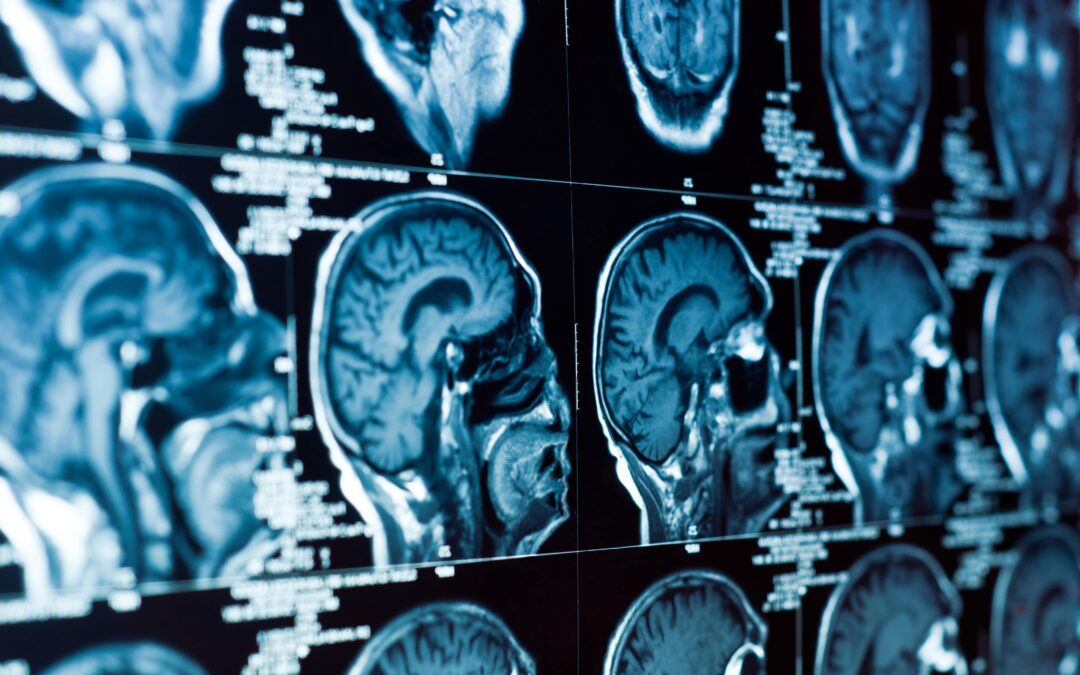 Understanding Brain Injury Claims